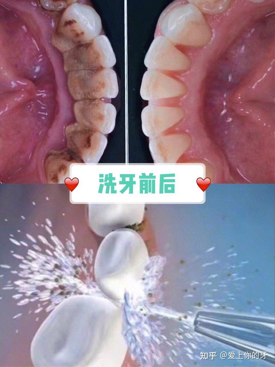 绵阳洗牙可以用医保吗(洗牙可以用医保吗,报销比例多少)